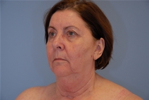 Facelift Before Photo by Raymond Mockler, MD; Panama City, FL - Case 23281