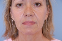 Facelift Before Photo by Raymond Mockler, MD; Panama City, FL - Case 23282