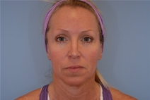Facelift Before Photo by Raymond Mockler, MD; Panama City, FL - Case 23283