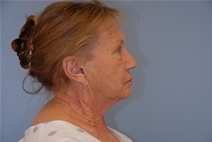 Facelift Before Photo by Raymond Mockler, MD; Panama City, FL - Case 23284
