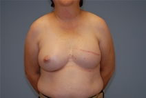 Breast Reconstruction After Photo by Raymond Mockler, MD; Panama City, FL - Case 23389