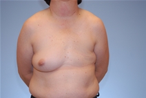 Breast Reconstruction Before Photo by Raymond Mockler, MD; Panama City, FL - Case 23389