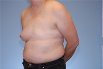 Breast Reconstruction Before Photo by Raymond Mockler, MD; Panama City, FL - Case 23389