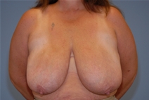 Breast Reduction Before Photo by Raymond Mockler, MD; Panama City, FL - Case 23391