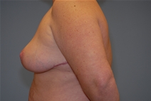 Breast Reduction After Photo by Raymond Mockler, MD; Panama City, FL - Case 23391