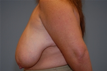 Breast Reduction Before Photo by Raymond Mockler, MD; Panama City, FL - Case 23391