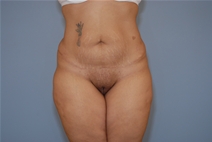 Tummy Tuck After Photo by Raymond Mockler, MD; Panama City, FL - Case 23429