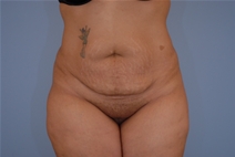 Tummy Tuck Before Photo by Raymond Mockler, MD; Panama City, FL - Case 23429
