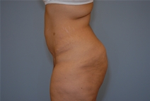 Tummy Tuck After Photo by Raymond Mockler, MD; Panama City, FL - Case 23429
