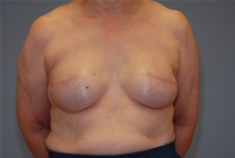 Breast Reconstruction After Photo by Raymond Mockler, MD; Panama City, FL - Case 23434