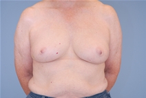 Breast Reconstruction Before Photo by Raymond Mockler, MD; Panama City, FL - Case 23434