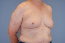 Breast Reconstruction Before Photo by Raymond Mockler, MD; Panama City, FL - Case 23434