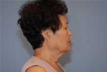 Facelift Before Photo by Raymond Mockler, MD; Panama City, FL - Case 23435