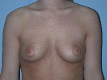 Breast Augmentation Before Photo by Raymond Mockler, MD; Panama City, FL - Case 7498