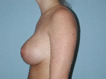 Breast Augmentation After Photo by Raymond Mockler, MD; Panama City, FL - Case 7498
