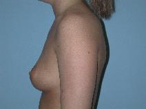 Breast Augmentation Before Photo by Raymond Mockler, MD; Panama City, FL - Case 7498