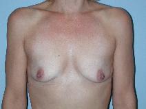 Breast Augmentation Before Photo by Raymond Mockler, MD; Panama City, FL - Case 7500
