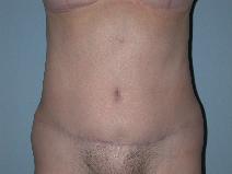 Tummy Tuck After Photo by Raymond Mockler, MD; Panama City, FL - Case 7501