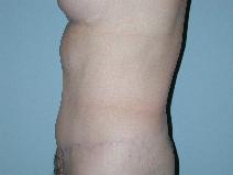 Tummy Tuck After Photo by Raymond Mockler, MD; Panama City, FL - Case 7501
