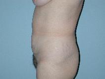 Tummy Tuck Before Photo by Raymond Mockler, MD; Panama City, FL - Case 7501