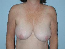 Breast Reduction Before Photo by Raymond Mockler, MD; Panama City, FL - Case 7503