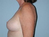 Breast Reduction After Photo by Raymond Mockler, MD; Panama City, FL - Case 7503