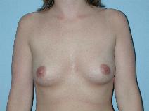 Breast Augmentation Before Photo by Raymond Mockler, MD; Panama City, FL - Case 7530
