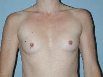Breast Augmentation Before Photo by Raymond Mockler, MD; Panama City, FL - Case 8456