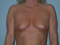 Breast Augmentation Before Photo by Raymond Mockler, MD; Panama City, FL - Case 8457