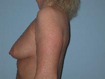 Breast Augmentation Before Photo by Raymond Mockler, MD; Panama City, FL - Case 8457