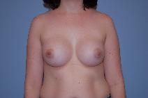 Breast Augmentation After Photo by Raymond Mockler, MD; Panama City, FL - Case 8458