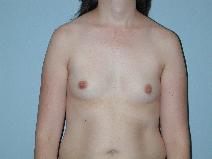 Breast Augmentation Before Photo by Raymond Mockler, MD; Panama City, FL - Case 8458