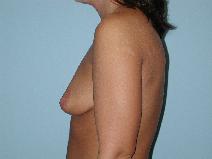 Breast Augmentation Before Photo by Raymond Mockler, MD; Panama City, FL - Case 8460
