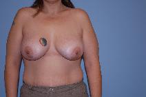 Breast Augmentation After Photo by Raymond Mockler, MD; Panama City, FL - Case 8461