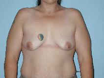 Breast Augmentation Before Photo by Raymond Mockler, MD; Panama City, FL - Case 8461