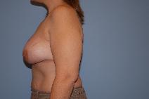 Breast Augmentation After Photo by Raymond Mockler, MD; Panama City, FL - Case 8461