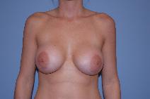 Breast Augmentation After Photo by Raymond Mockler, MD; Panama City, FL - Case 8463