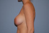 Breast Augmentation After Photo by Raymond Mockler, MD; Panama City, FL - Case 8463