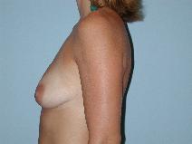 Breast Augmentation Before Photo by Raymond Mockler, MD; Panama City, FL - Case 8463