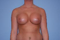 Breast Augmentation After Photo by Raymond Mockler, MD; Panama City, FL - Case 8464