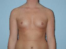 Breast Augmentation Before Photo by Raymond Mockler, MD; Panama City, FL - Case 8464