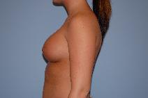 Breast Augmentation After Photo by Raymond Mockler, MD; Panama City, FL - Case 8464