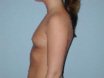 Breast Augmentation Before Photo by Raymond Mockler, MD; Panama City, FL - Case 8464