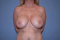 Breast Augmentation After Photo by Raymond Mockler, MD; Panama City, FL - Case 8465