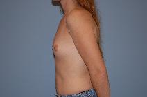 Breast Augmentation Before Photo by Raymond Mockler, MD; Panama City, FL - Case 8466