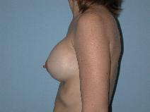 Breast Augmentation After Photo by Raymond Mockler, MD; Panama City, FL - Case 8468