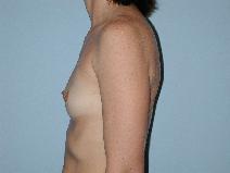 Breast Augmentation Before Photo by Raymond Mockler, MD; Panama City, FL - Case 8468