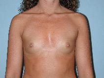 Breast Augmentation Before Photo by Raymond Mockler, MD; Panama City, FL - Case 8469
