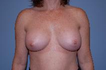 Breast Augmentation After Photo by Raymond Mockler, MD; Panama City, FL - Case 8474