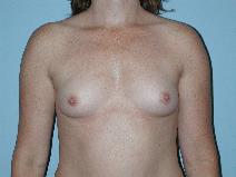 Breast Augmentation Before Photo by Raymond Mockler, MD; Panama City, FL - Case 8474
